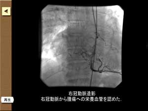 冠動脈造影が動画を含めて多数収録されています。