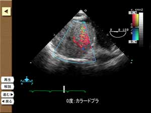 「進む」ボタンで症例ごとの心エコー図画像を連続でみることができます。
