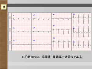 症例の心電図が見られます。